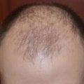 Отзыв о Сыворотка для роста волос D'umor Hair for men: Прощай лысина