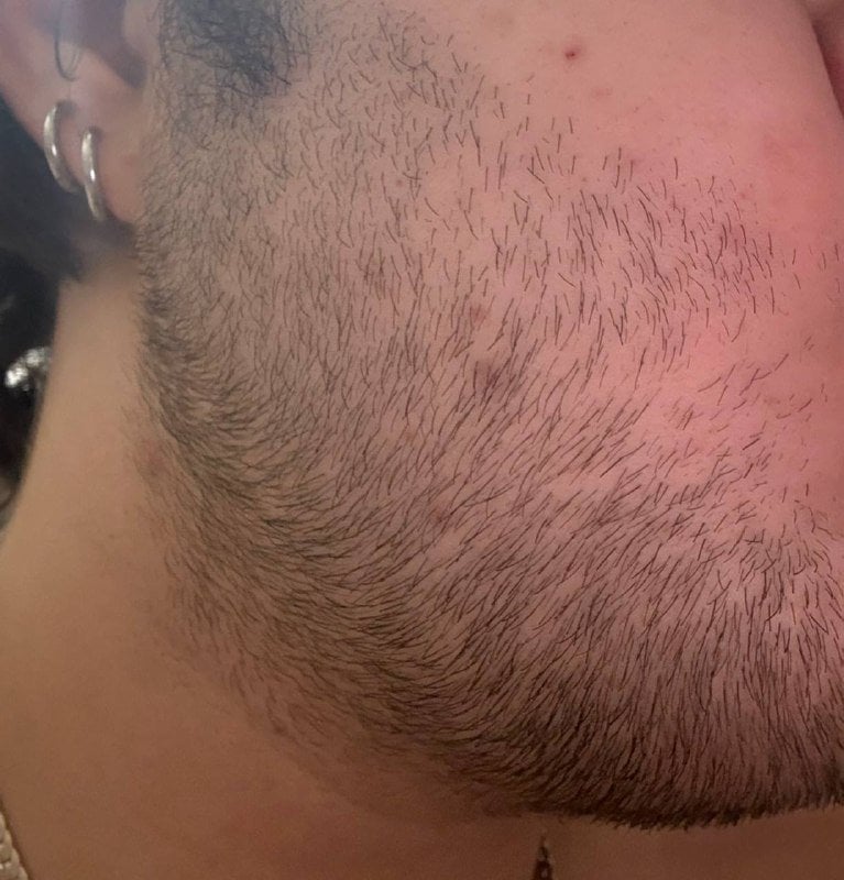 Сыворотка для роста волос D'umor Hair for men - Лучшее что пробовал ну и результативнее аналогов