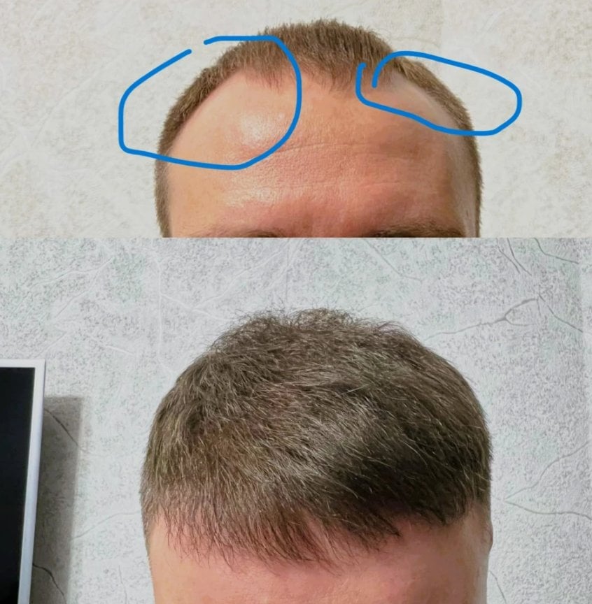 Сыворотка для роста волос D'umor Hair for men - Помогает реально, не чудо но работает.