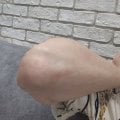 Отзыв о Оптидермал: Очень помог крем
