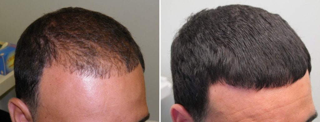 Сыворотка для роста волос D'umor Hair for men - Мой опыт с лосьоном для роста волос